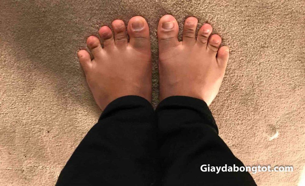 Người có bàn chân bè ngang sẽ rất kho khăn khi chọn giày đá bóng