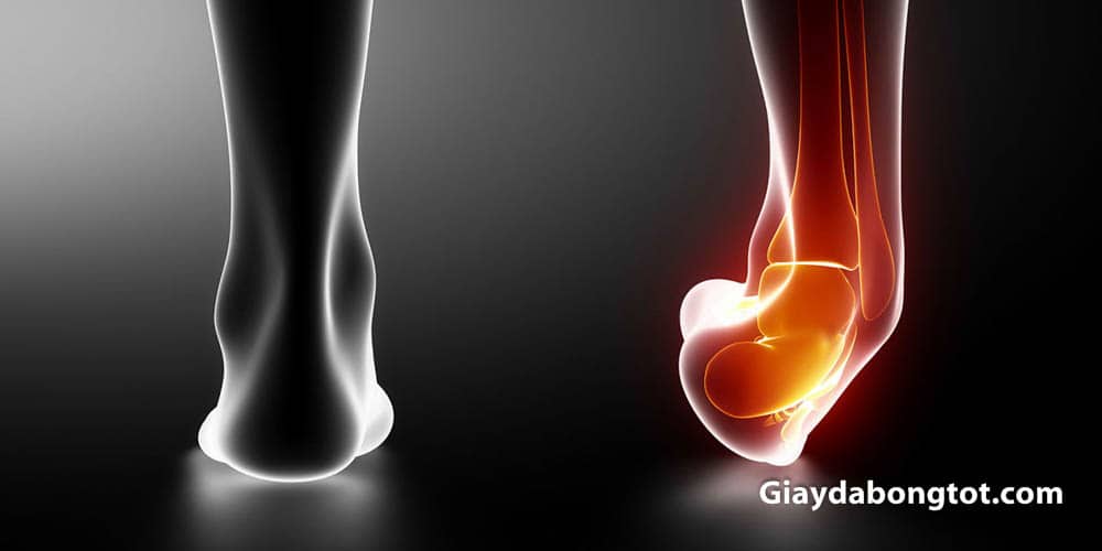 Lật cổ chân là một chấn thương phổ biến khi chơi bóng đá